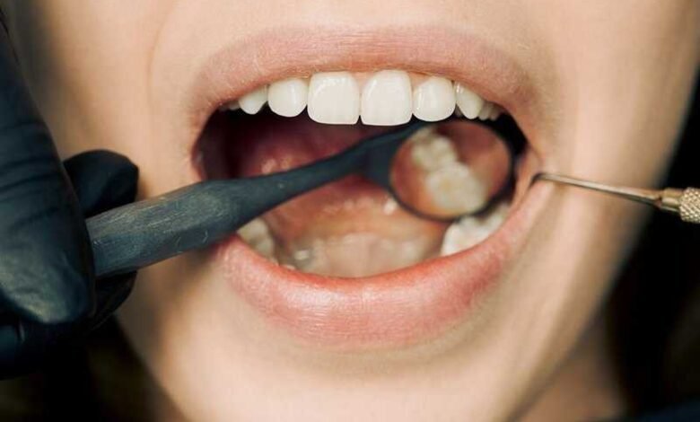 Tooth Cavities :दातो की कैविटी से बचने के लिए रखे इन खास बातो का ध्यान