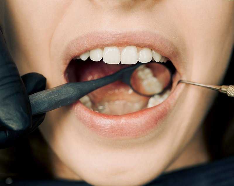Tooth Cavities :दातो की कैविटी से बचने के लिए रखे इन खास बातो का ध्यान