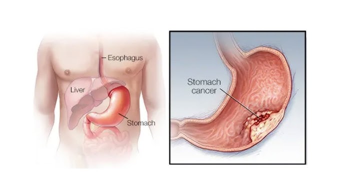 पेट में कैंसर होने से पहले दिखाई देने वाले ये लक्षण,जाने पूरी जानकारी